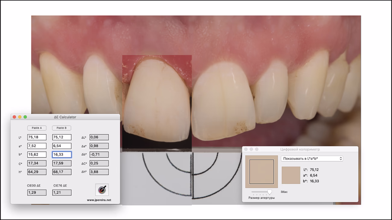 Збільшене зображення двох передніх зубів із порівнянням їх кольору за допомогою цифрового колориметра та калькулятора ΔE.