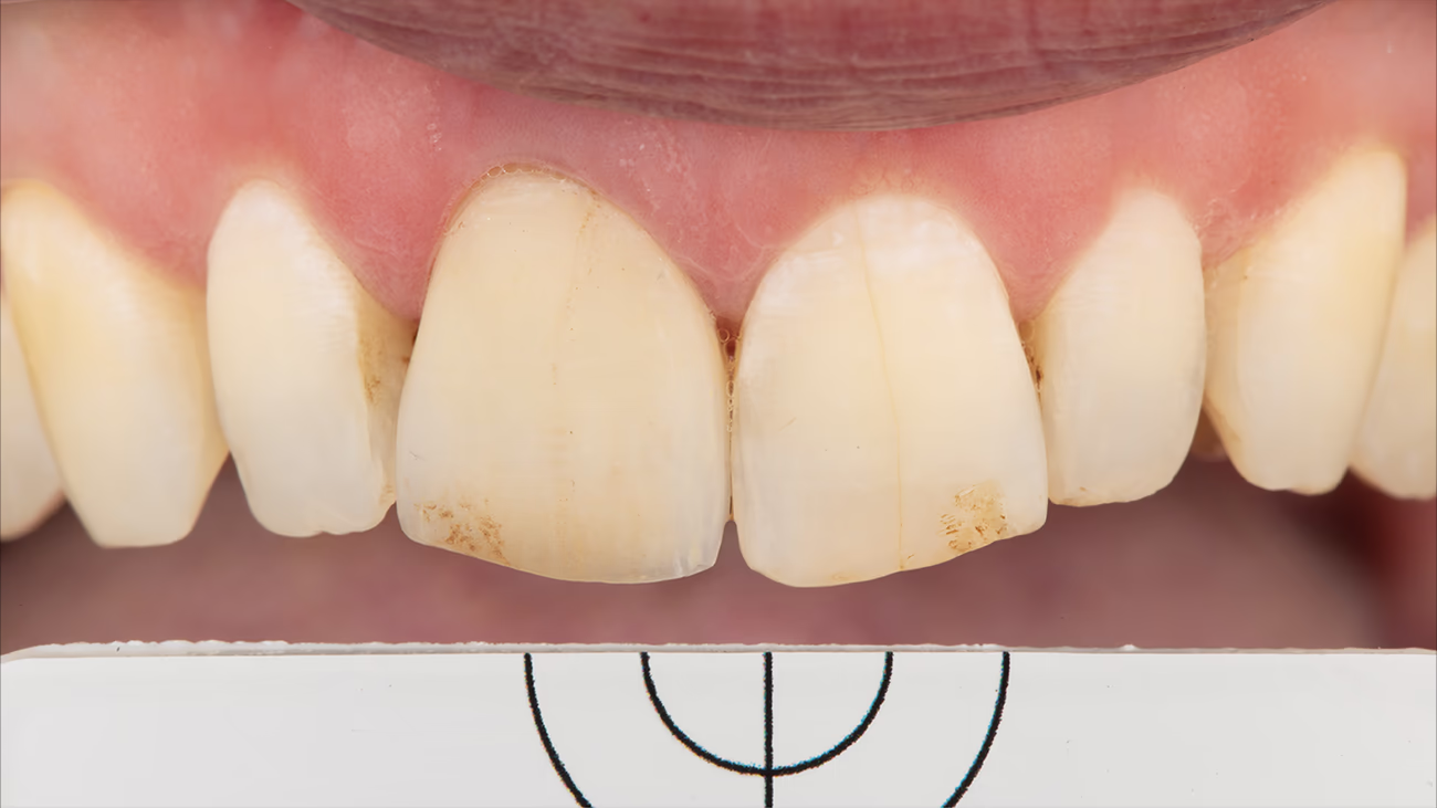 Фото зубів фіксації реставрації з поляризаційним фільтром
і сірою карткою.