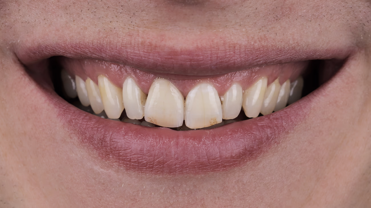 Фінальне фото усмішки після лікування