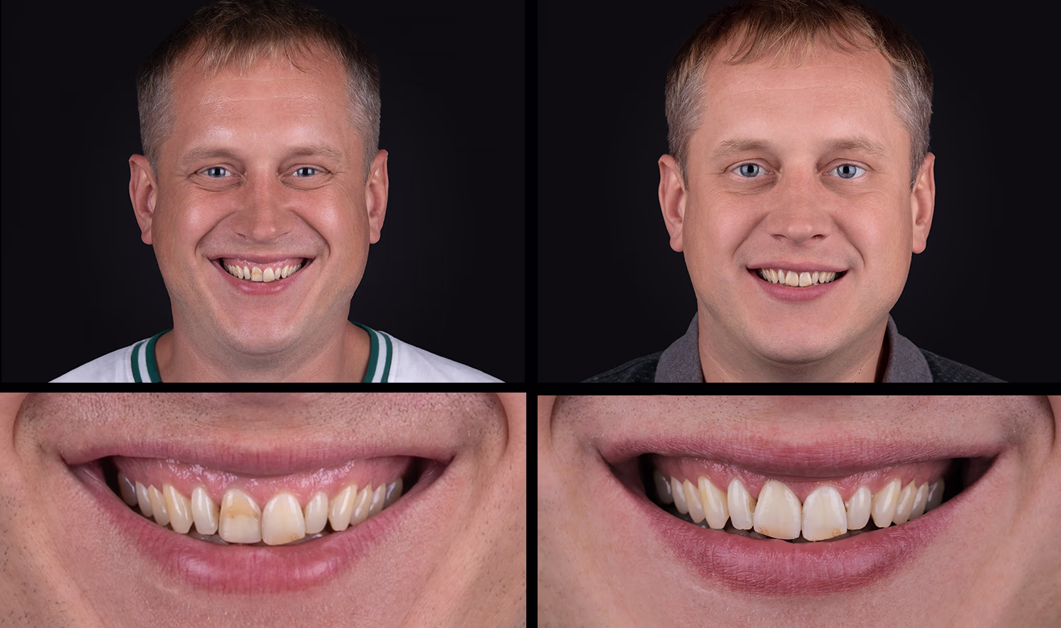 Портрет чоловіка з блискучою посмішкою на чорному фоні, поруч крупний план його зубів до і після лікування.