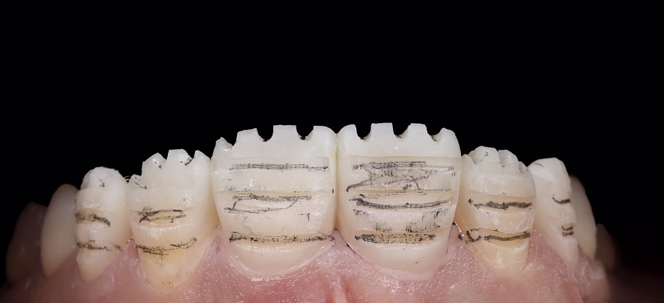 Вестибулярне маркування глибини препарування та редукції ріжучого краю.