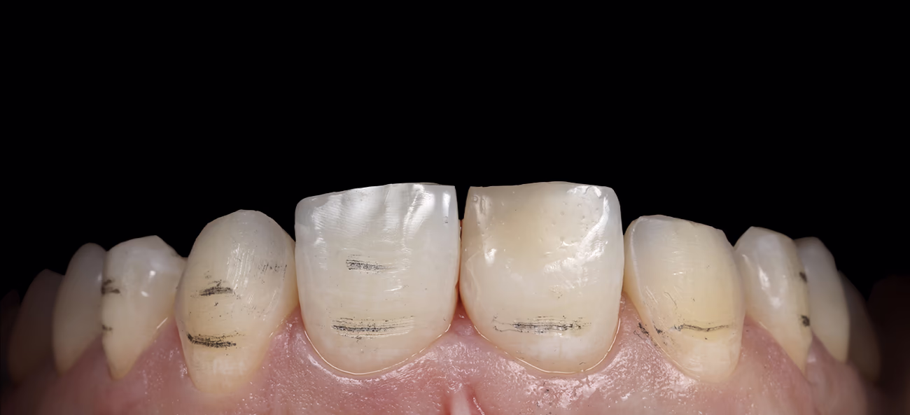 Маркування зон, що підлягають пришліфовуванню, після зняття mock-up