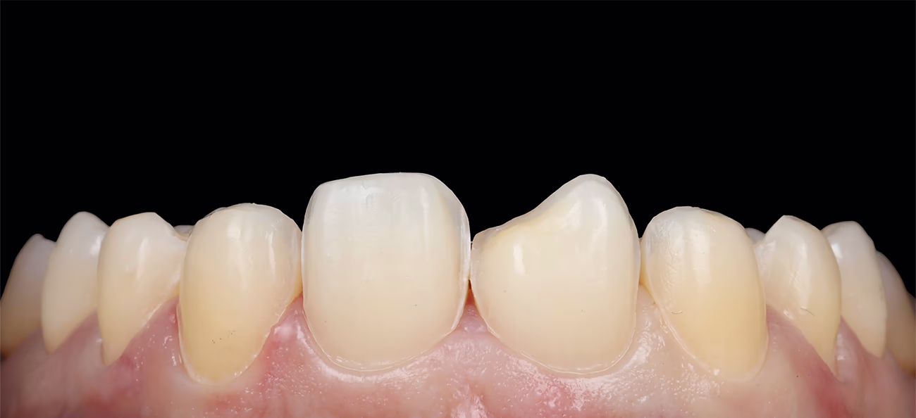 Вигляд зубів після препарування
