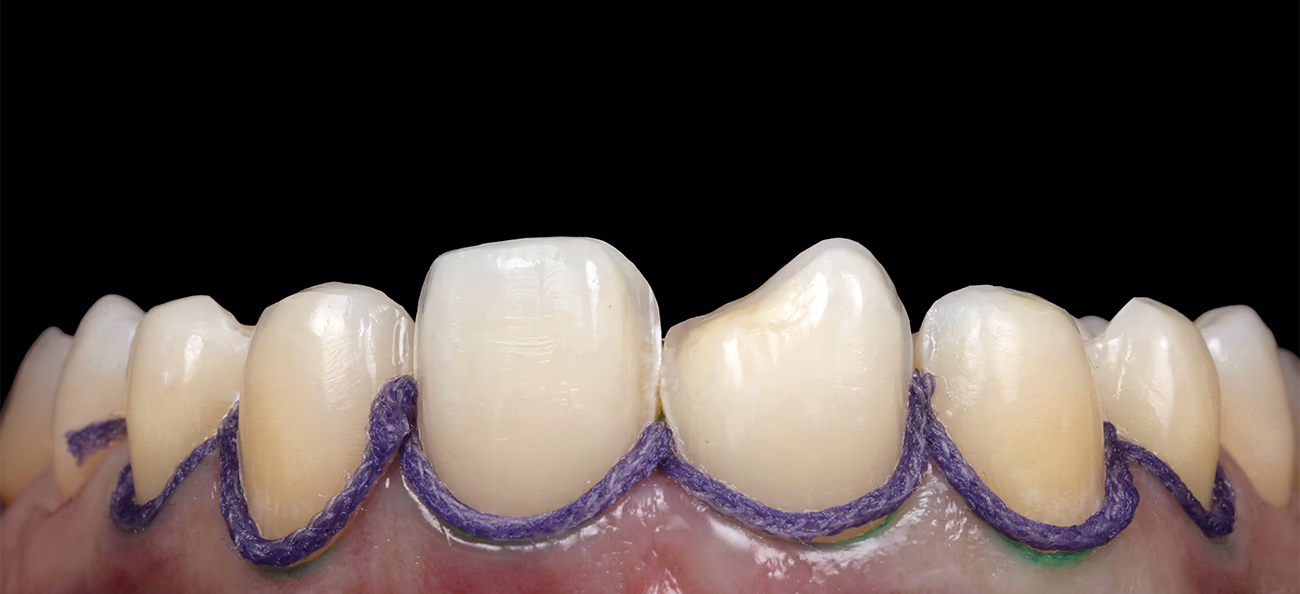 Встановлення другої нитки з просочуванням Sure-Cord 0