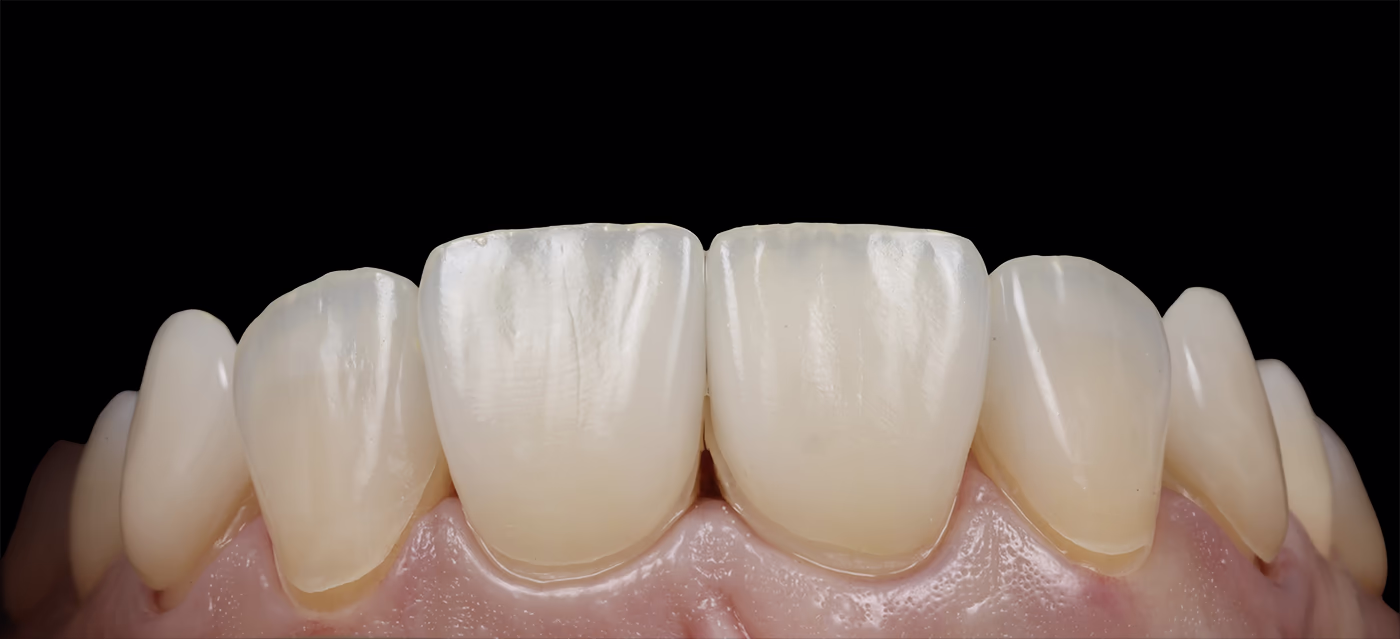 Етап Dry Fit — примірка вінірів на суху поверхню