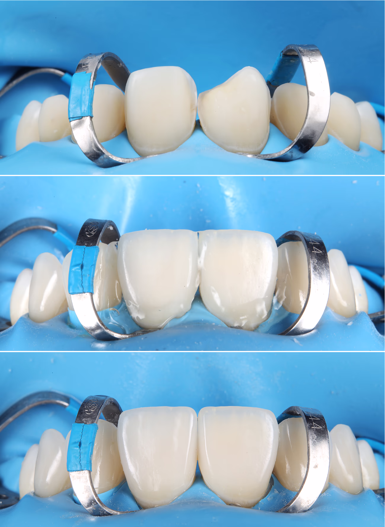 Три фотографії з етапу фіксації вінірів на зуби 11, 21