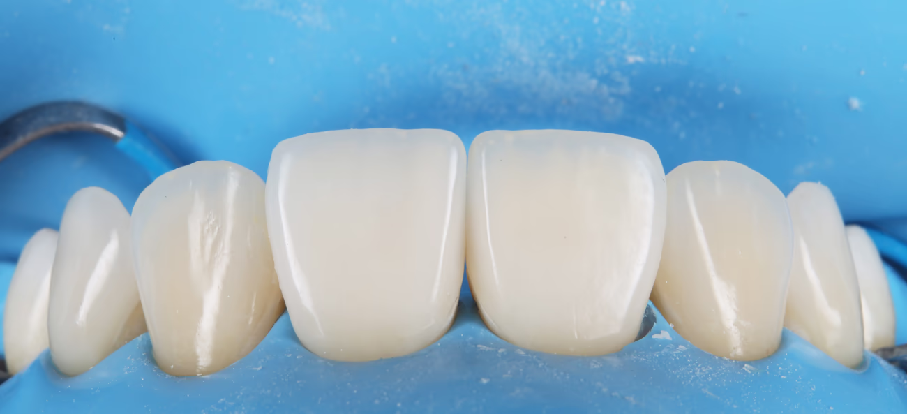 Вид після фіксацій вінірів на зуби 11,21