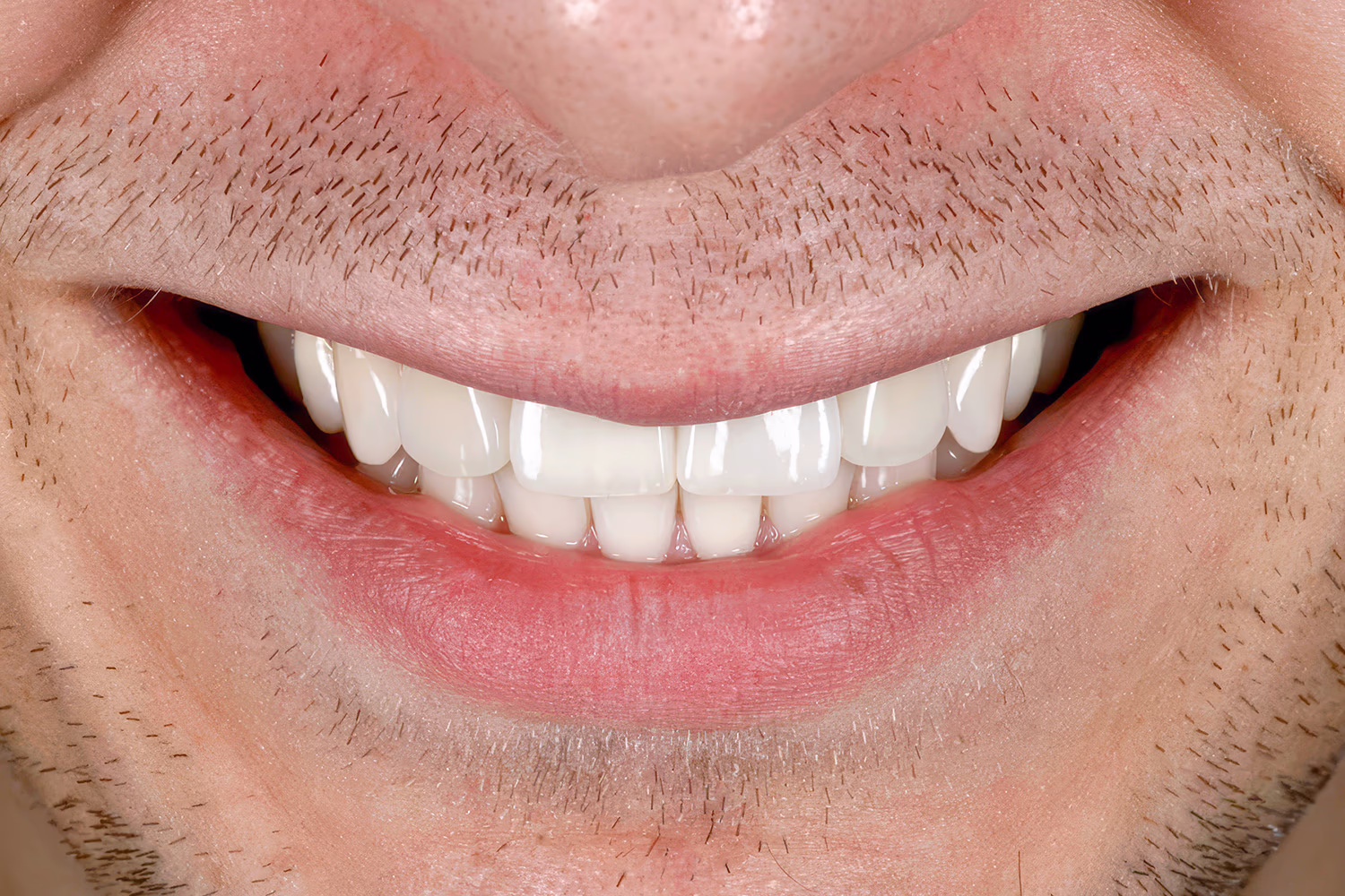 Посмішка пацієнта після встановлення шести вінірів