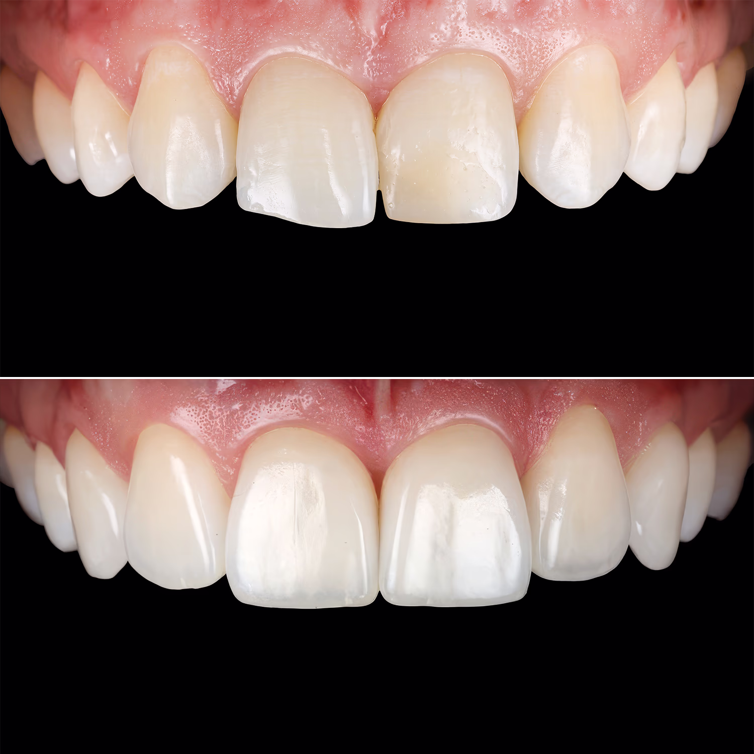 Порівняльний результат зубів до і після встановлення вінірів