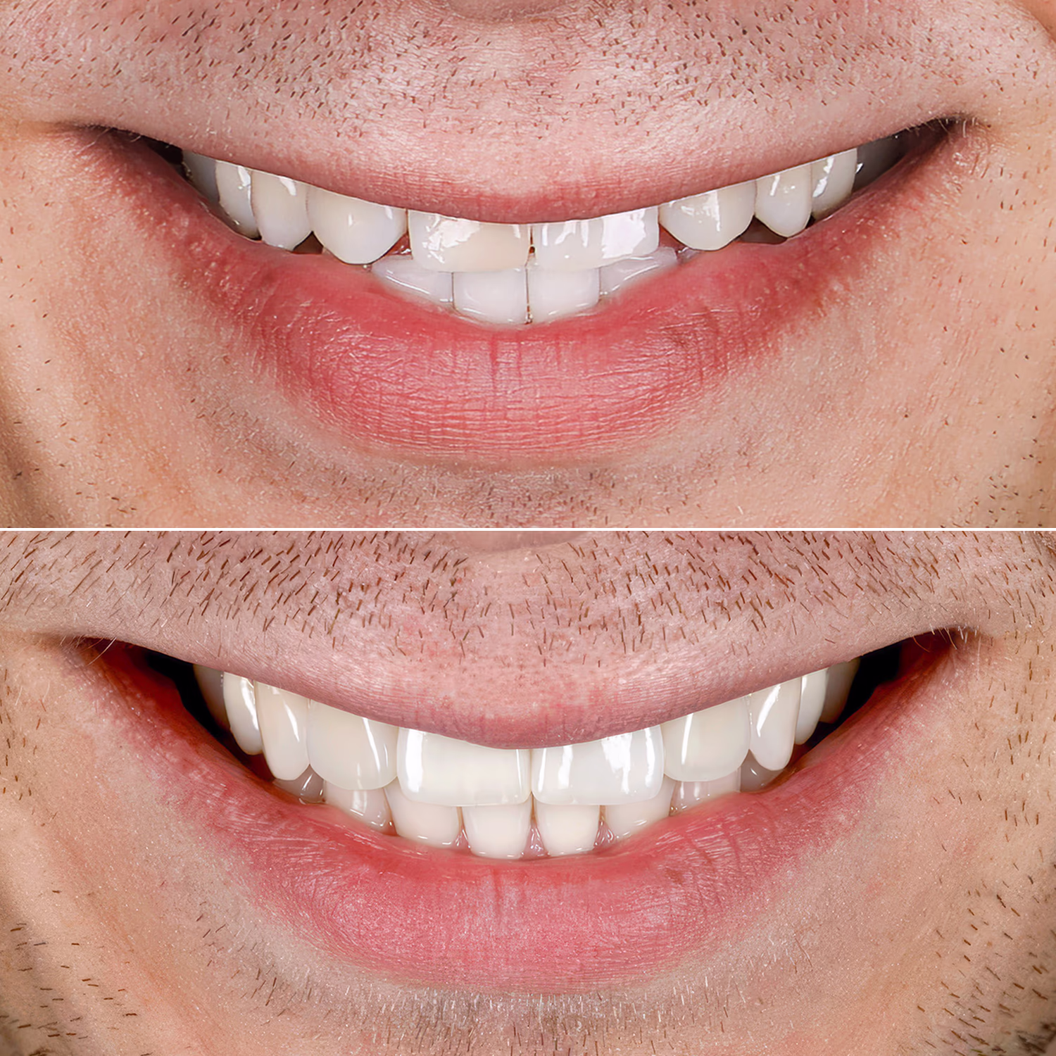 Порівняння посмішки пацієнта до і після встановлення вінірів