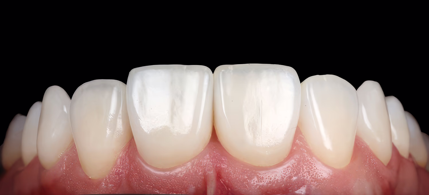 Заключний вигляд після фіксації шести вінірів