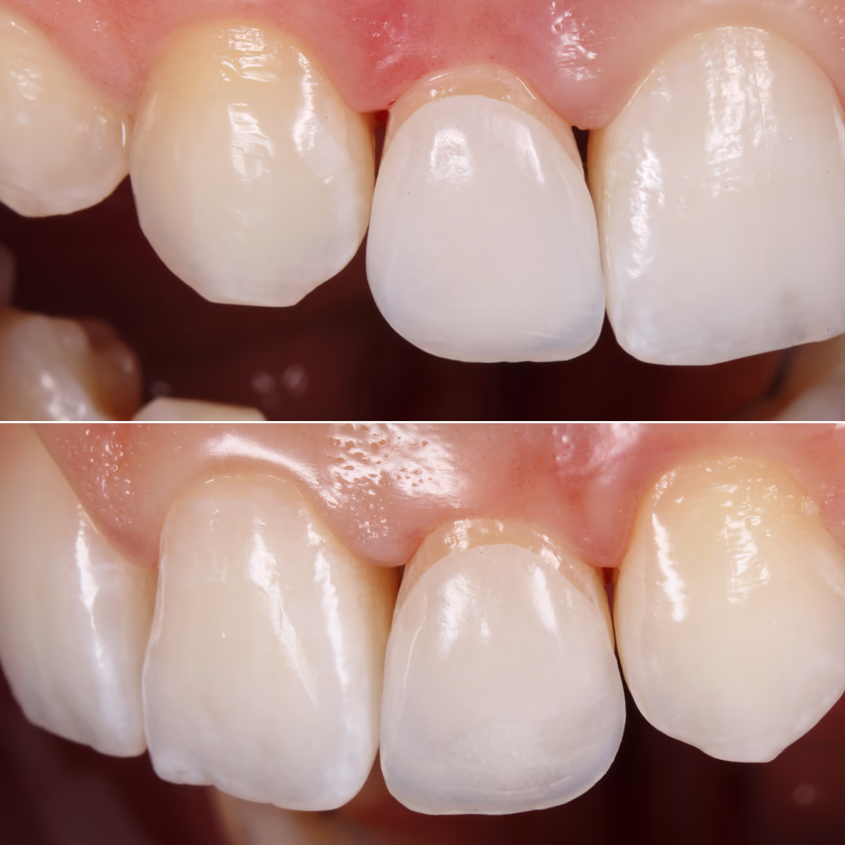 Примірка вінірів на суху поверхню (Dry Fit)