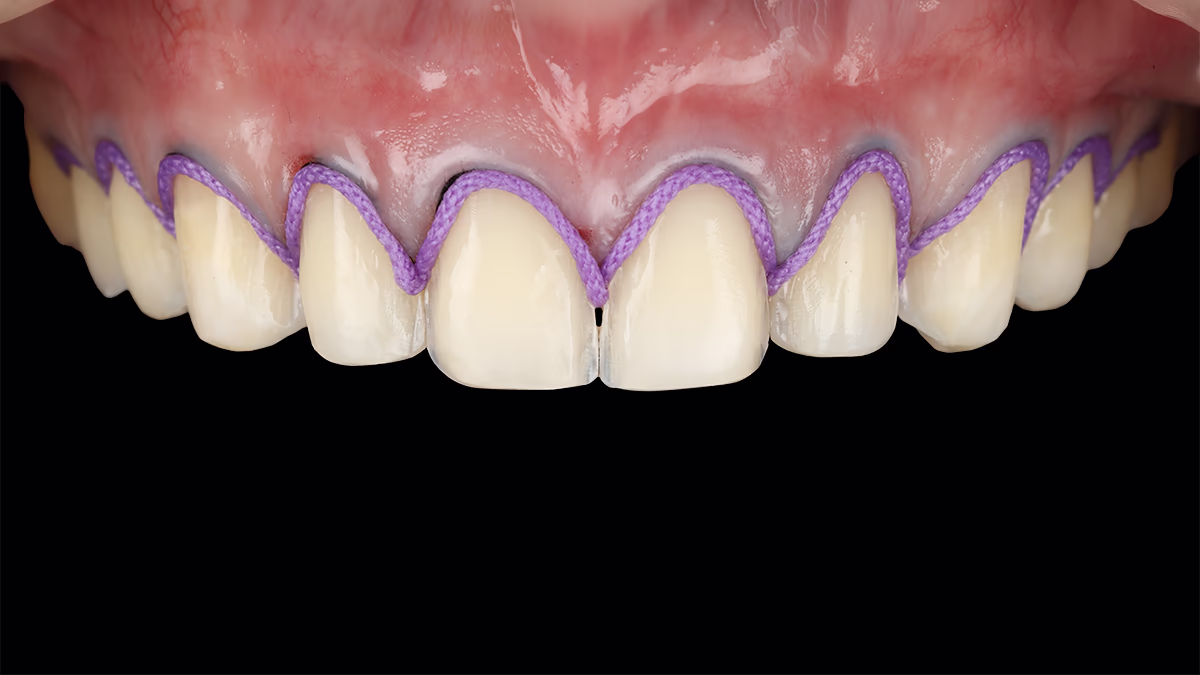 Процесс минимального препарирования зубов перед установкой виниров.