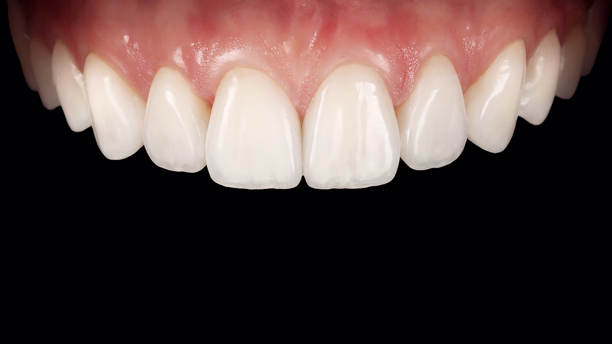Фиксация постоянных керамических виниров с естественным видом зубов.