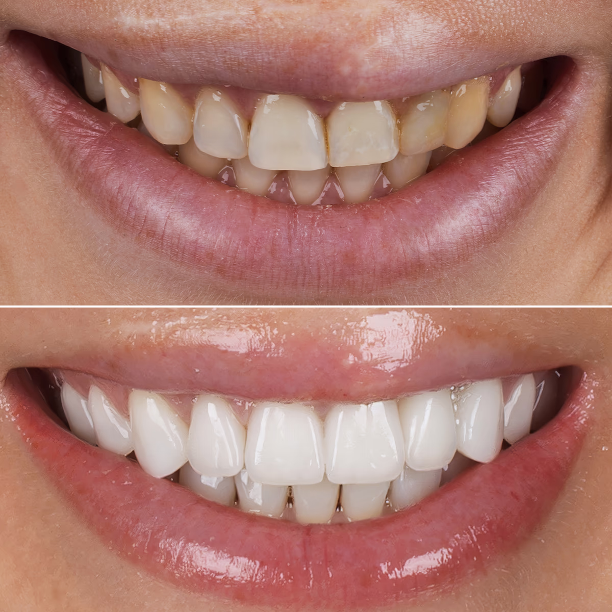 Клинический пример реставрации зубов керамическими винирами.