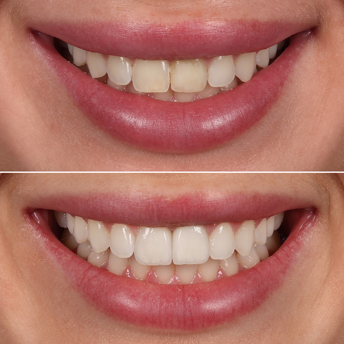 Результат эстетического лечения – естественная белая улыбка.