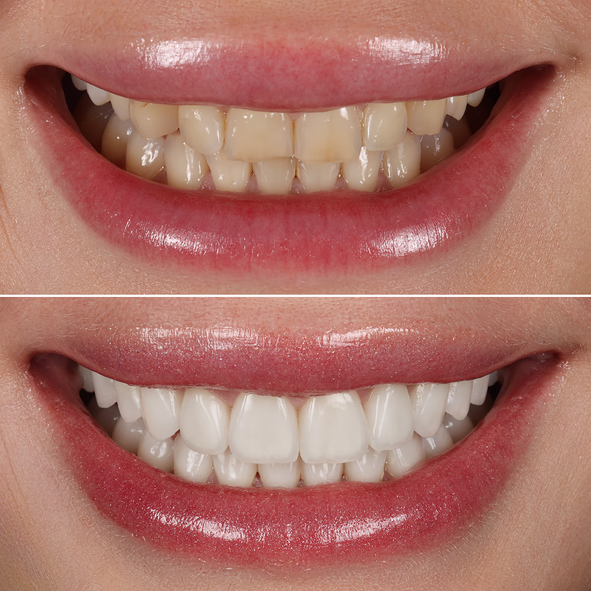 Эстетическая трансформация улыбки пациента после лечения и установления виниров