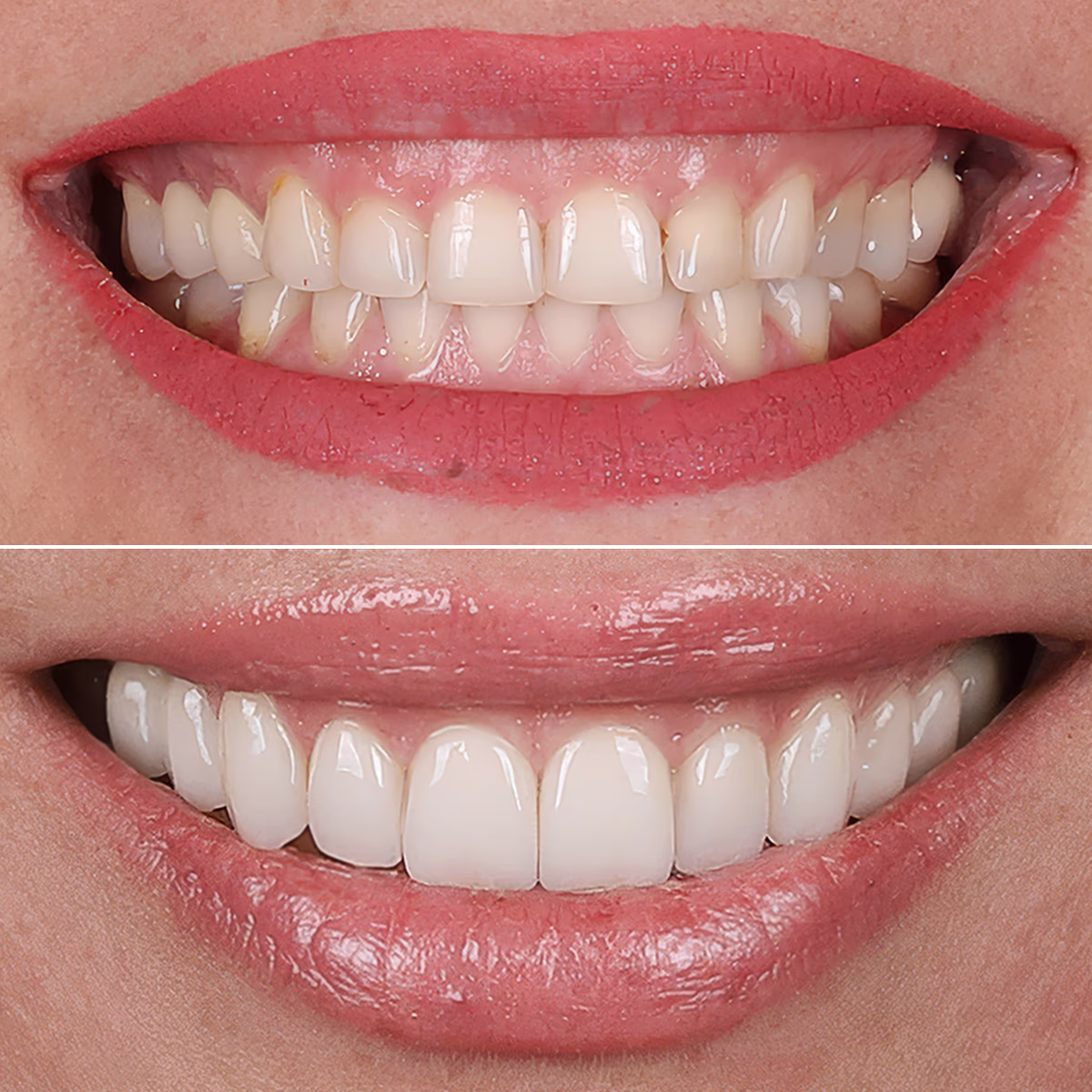 Клинический кейс отбеливания и установки виниров.