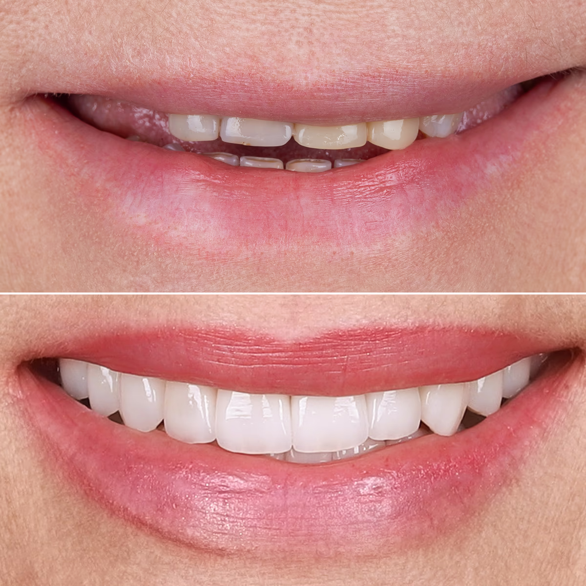 Результат работы: ровная и естественная ухмылка после виниров.