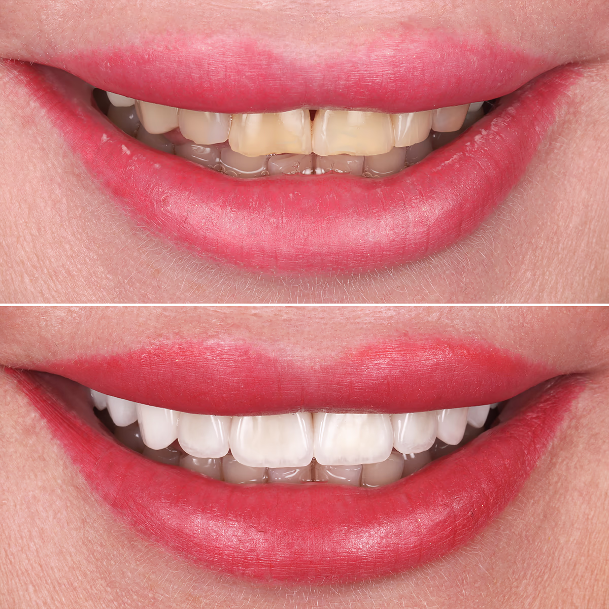 Улыбка пациентки до и после установки керамических виниров.