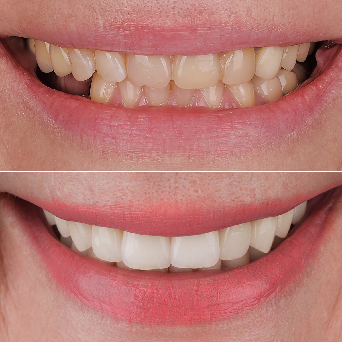 Восстановление эстетики улыбки с помощью цифрового планирования и виниров.