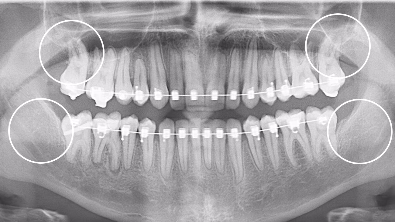 Панорамний знімок після видалення зубів мудрості під час ортодонтичного лікування