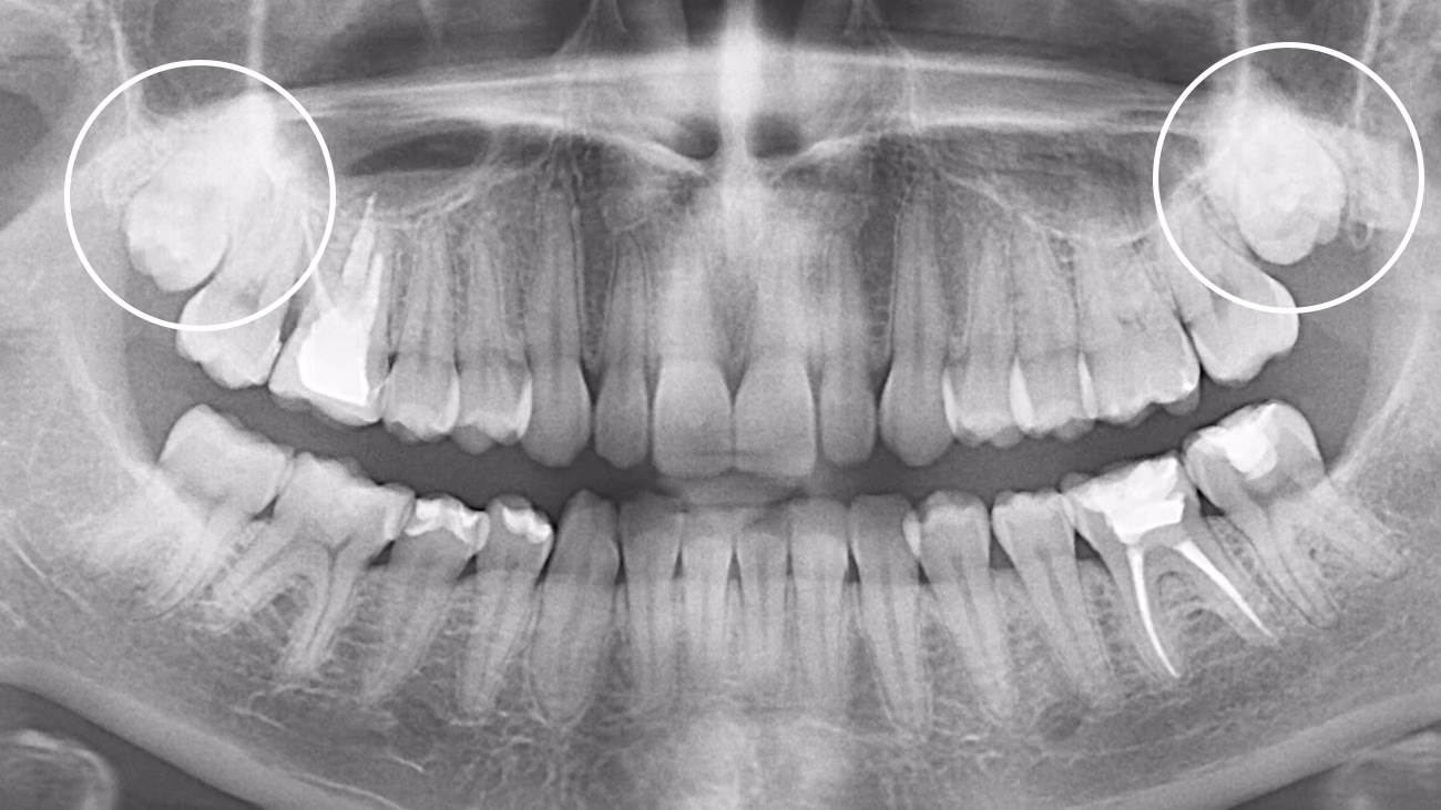 Панорамний знімок до видалення зубів мудрості — складне положення та близькість до анатомічних структур
