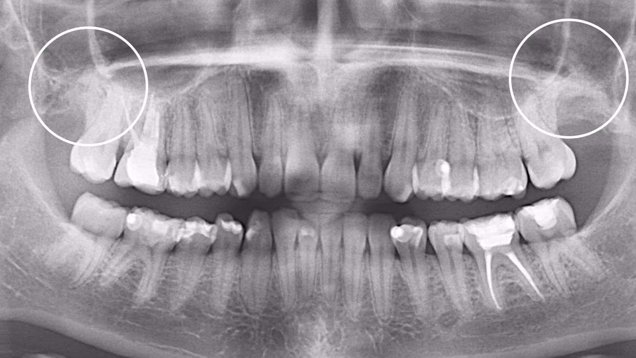 Панорамний знімок після складного видалення зубів мудрості — контроль загоєння