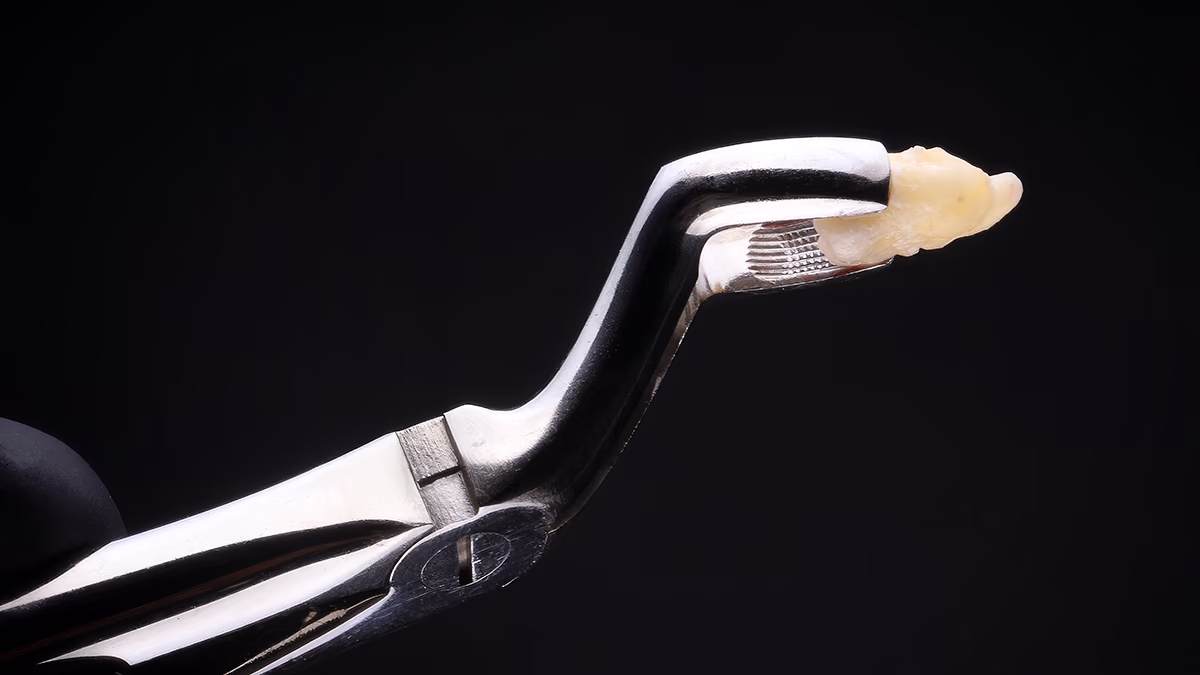 Оцінка складності видалення зуба мудрості залежно від положення та анатомії