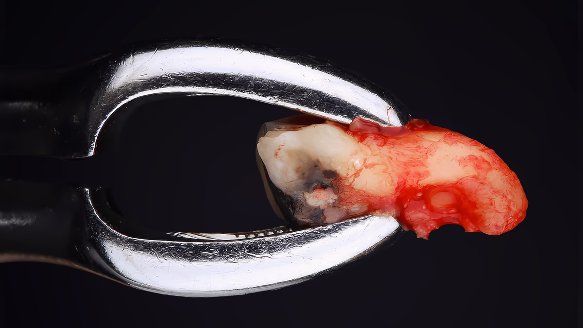 Хірургічне видалення зуба мудрості із застосуванням атравматичних технік