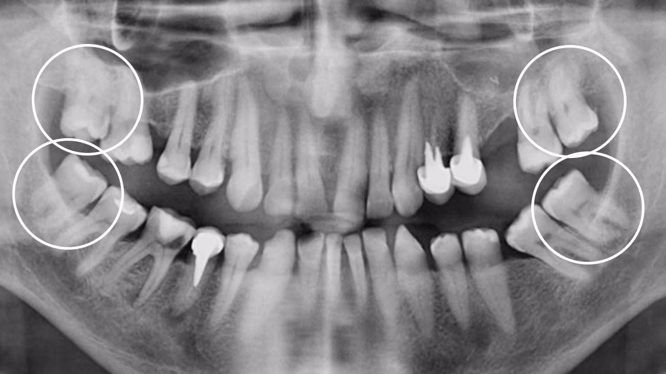 Панорамний знімок до видалення зубів мудрості — ретиновані восьмі зуби верхньої та нижньої щелепи