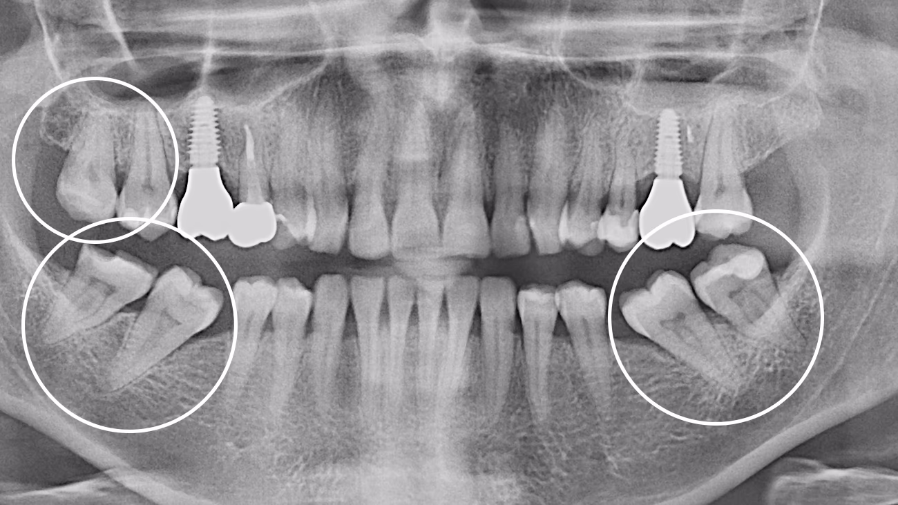 Панорамні рентгенівські знімки щелепи з позначеними ділянками, де видно зубні імпланти, коронки та розташування зубів мудрості.
