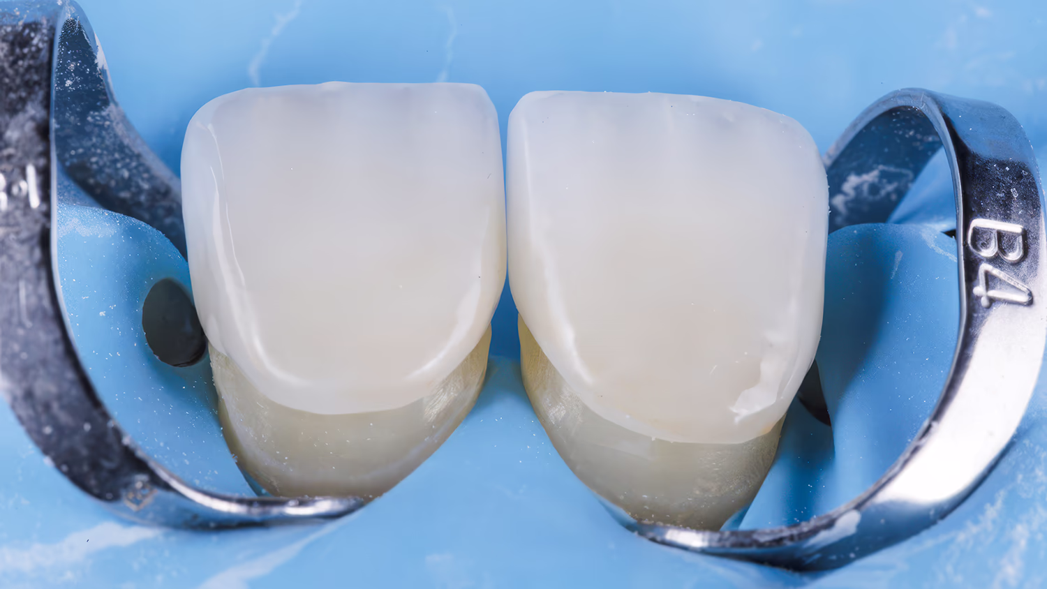Clinical photo of front teeth with ceramic restorations under insulation