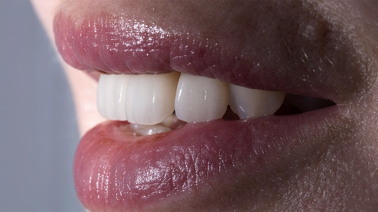 Боковой вид улыбки с керамическими винирами на передних зубах