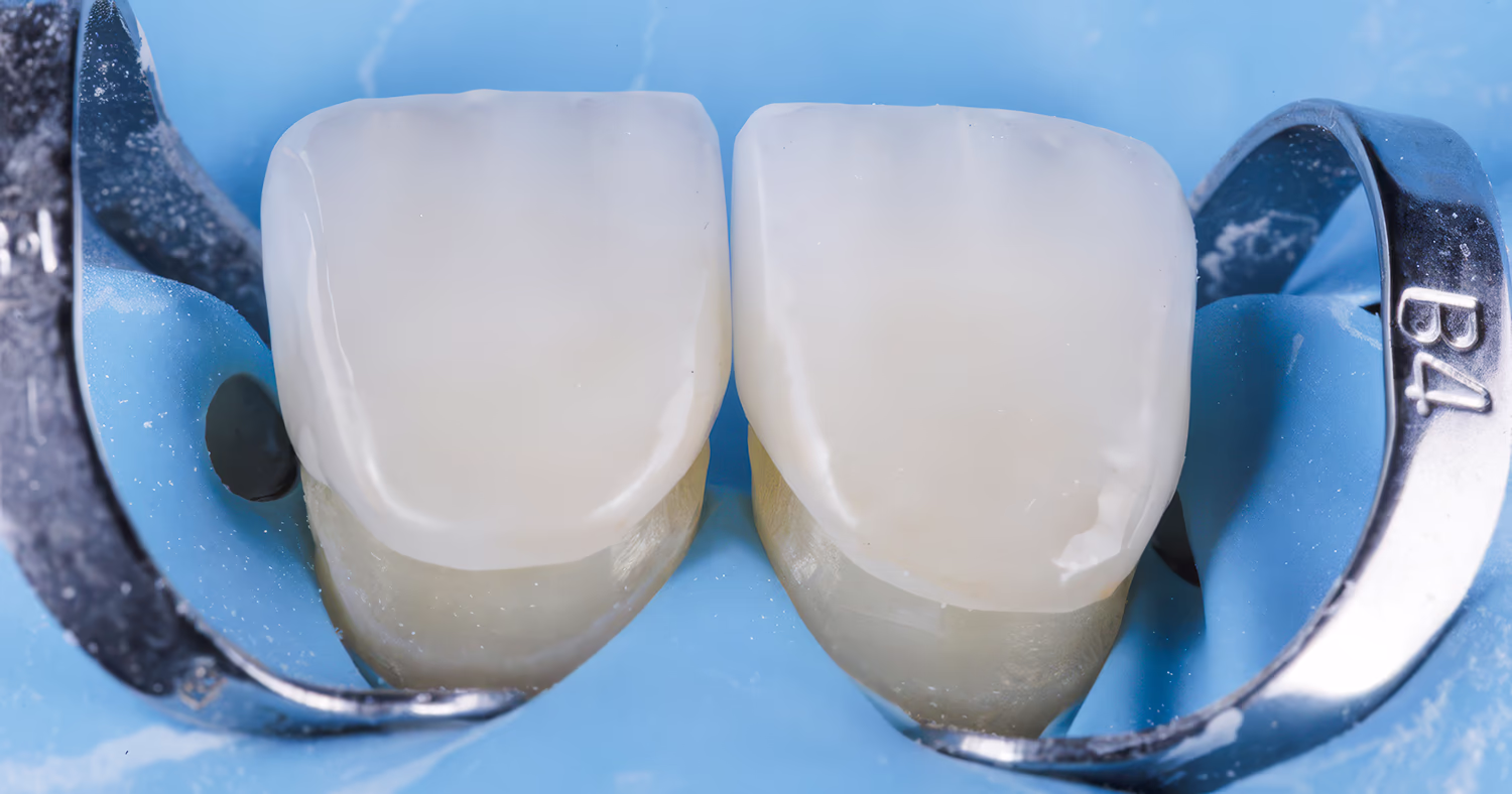 Клінічне фото передніх зубів з керамічними реставраціями під ізоляцією