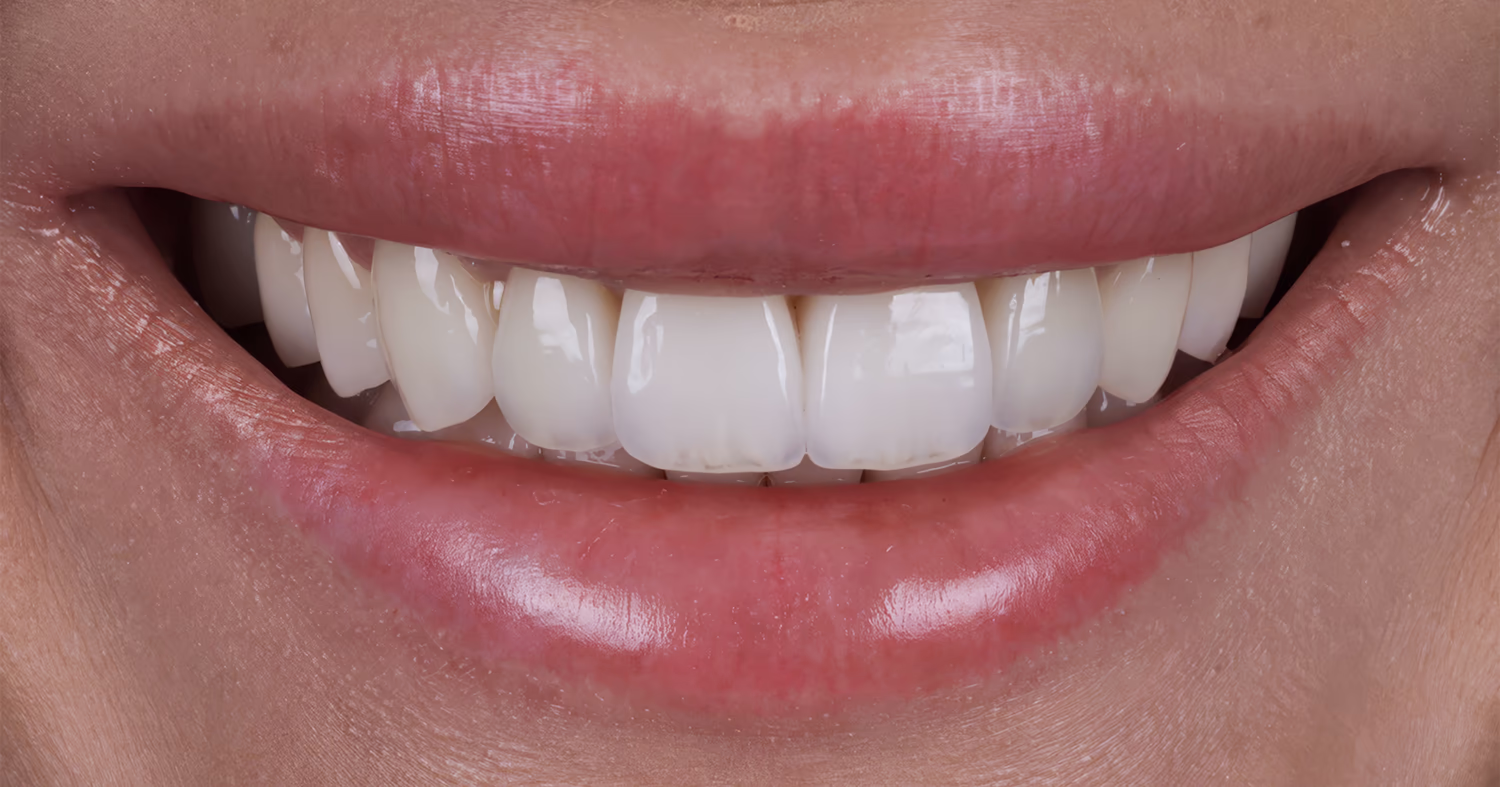 Голливудская улыбка с еще более светлыми зубами после эстетического стоматологического лечения