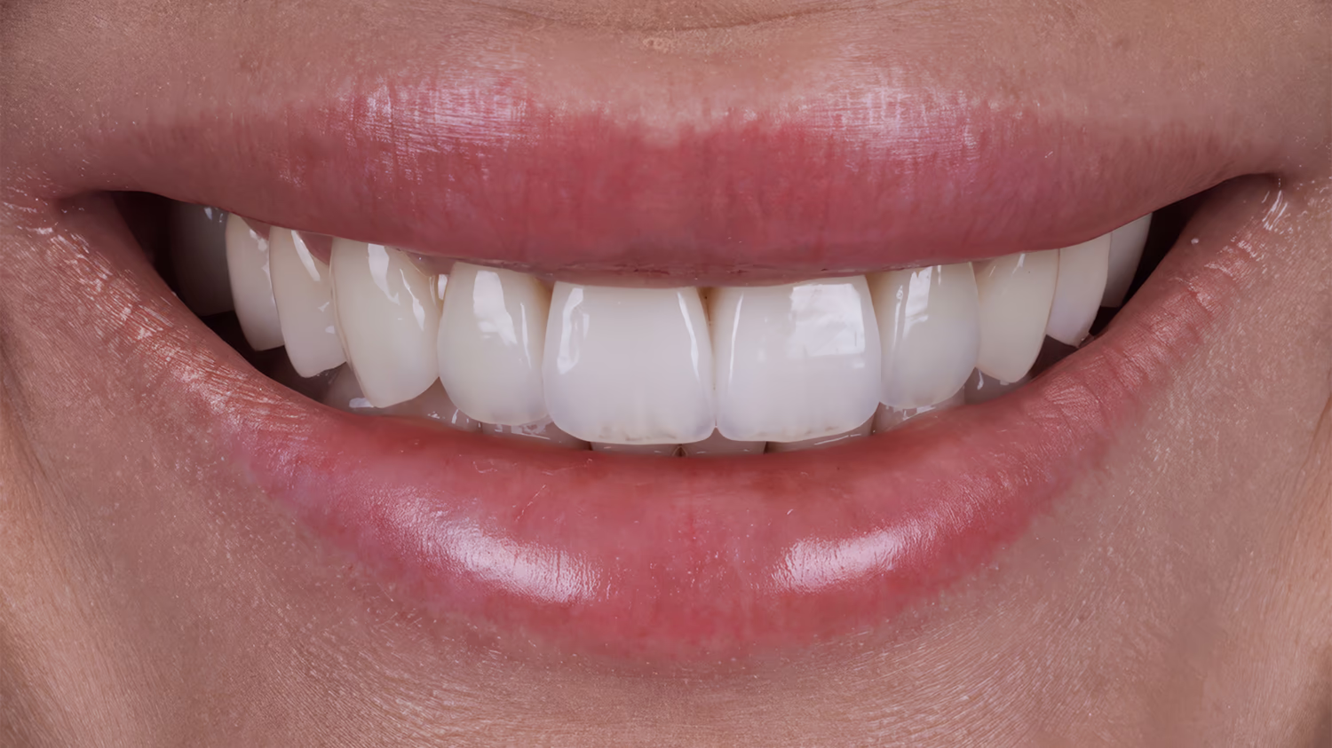 Голівудська усмішка з рівними світлими зубами після естетичного стоматологічного лікування