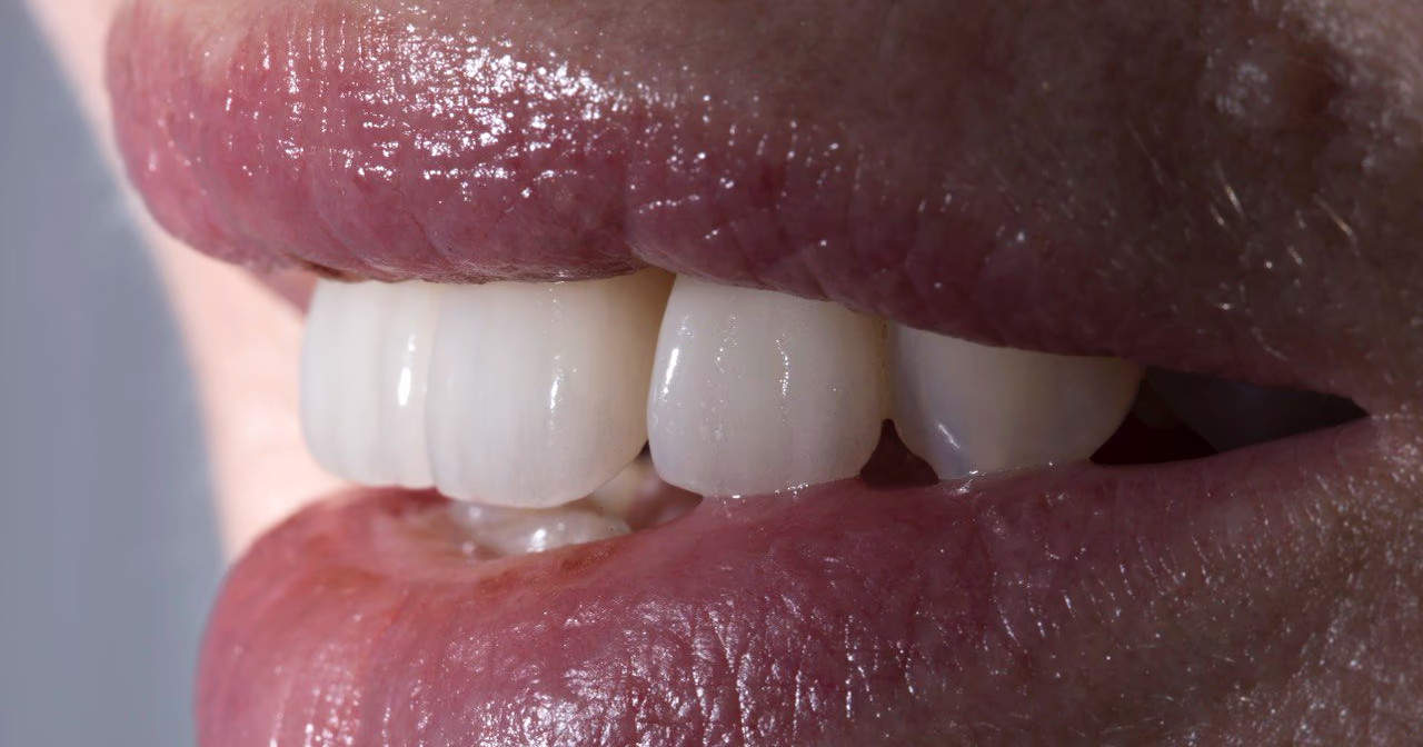 Боковий вигляд усмішки з керамічними вінірами на передніх зубах