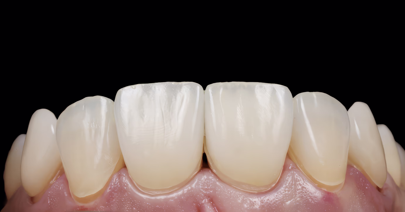 Крупний план керамічних вінірів на передніх зубах під час примірки перед фіксацією