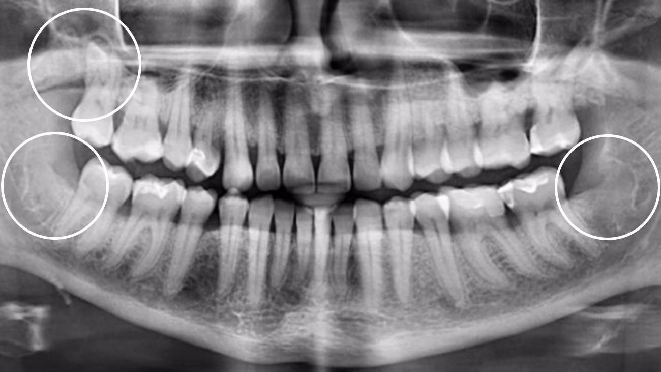 Ортопантомограма після видалення трьох зубів мудрості