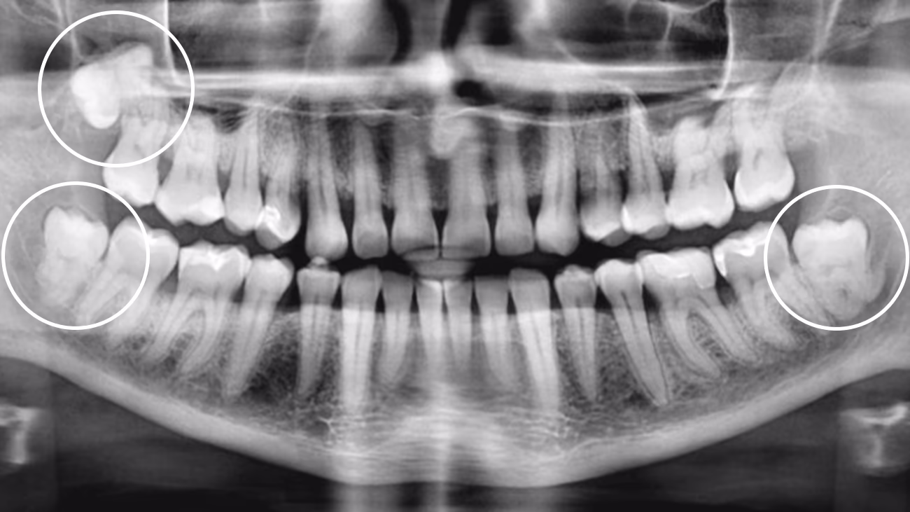 Ортопантомограма до видалення трьох зубів мудрості