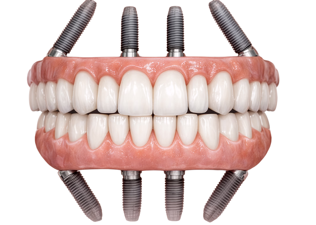 Система зубних імплантів All-on-X, що демонструє повне відновлення зубної дуги за допомогою кількох імплантатів