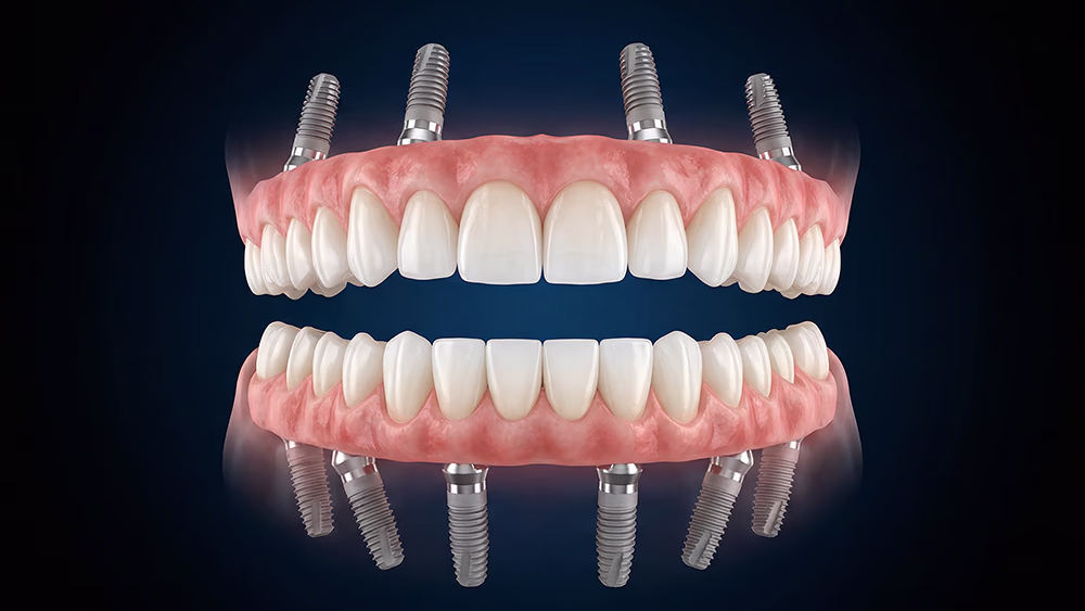 Система All-on-X — повне відновлення зубів на кількох імплантах у верхній та нижній щелепі