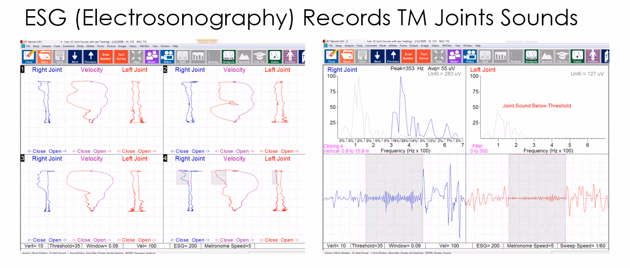 Electrosonography (ESG)