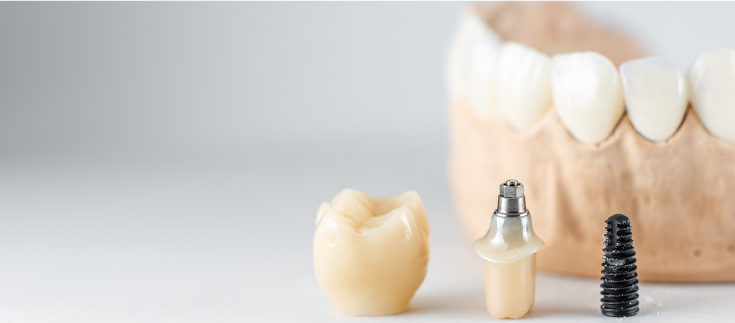 Dental crown, abutment with crown, and dental implant screw in front of a dental model with teeth.