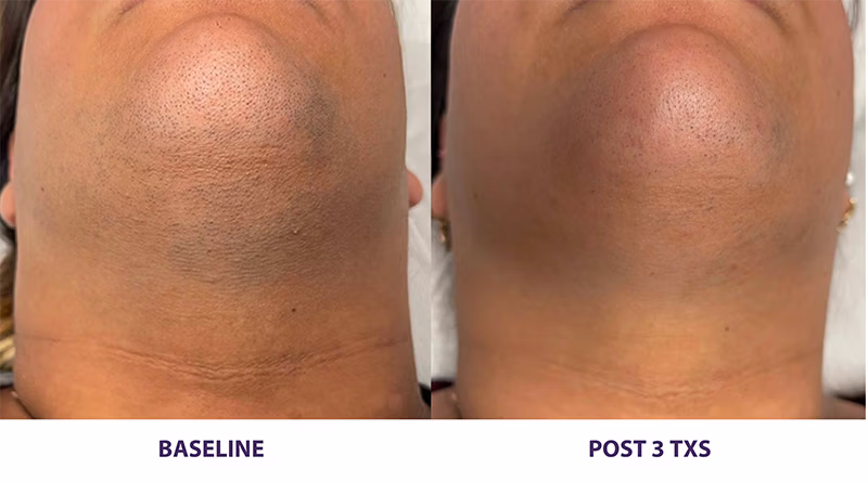 Before & After with the Soprano Ice Laser