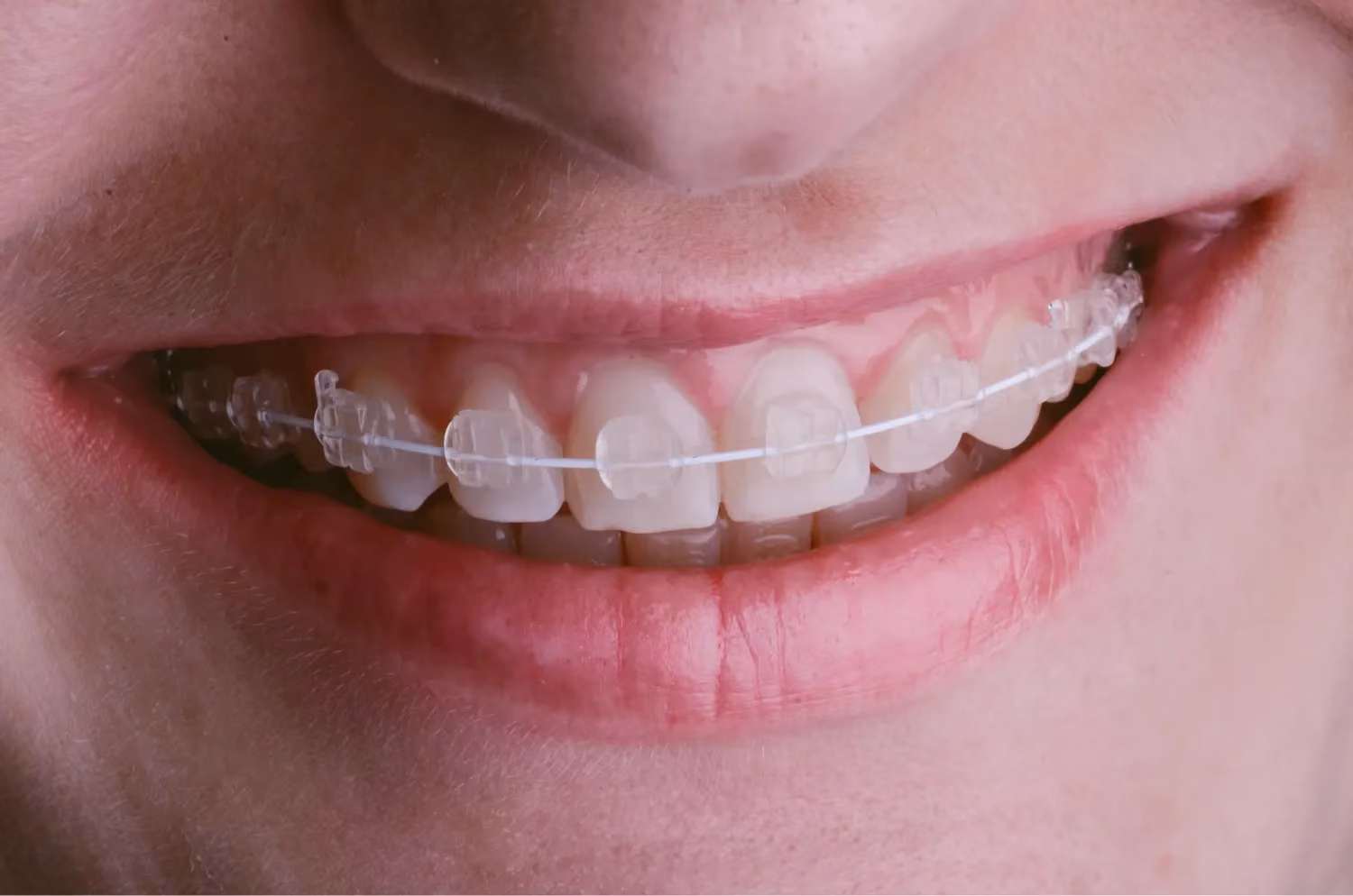 Clear Braces for All Ages
