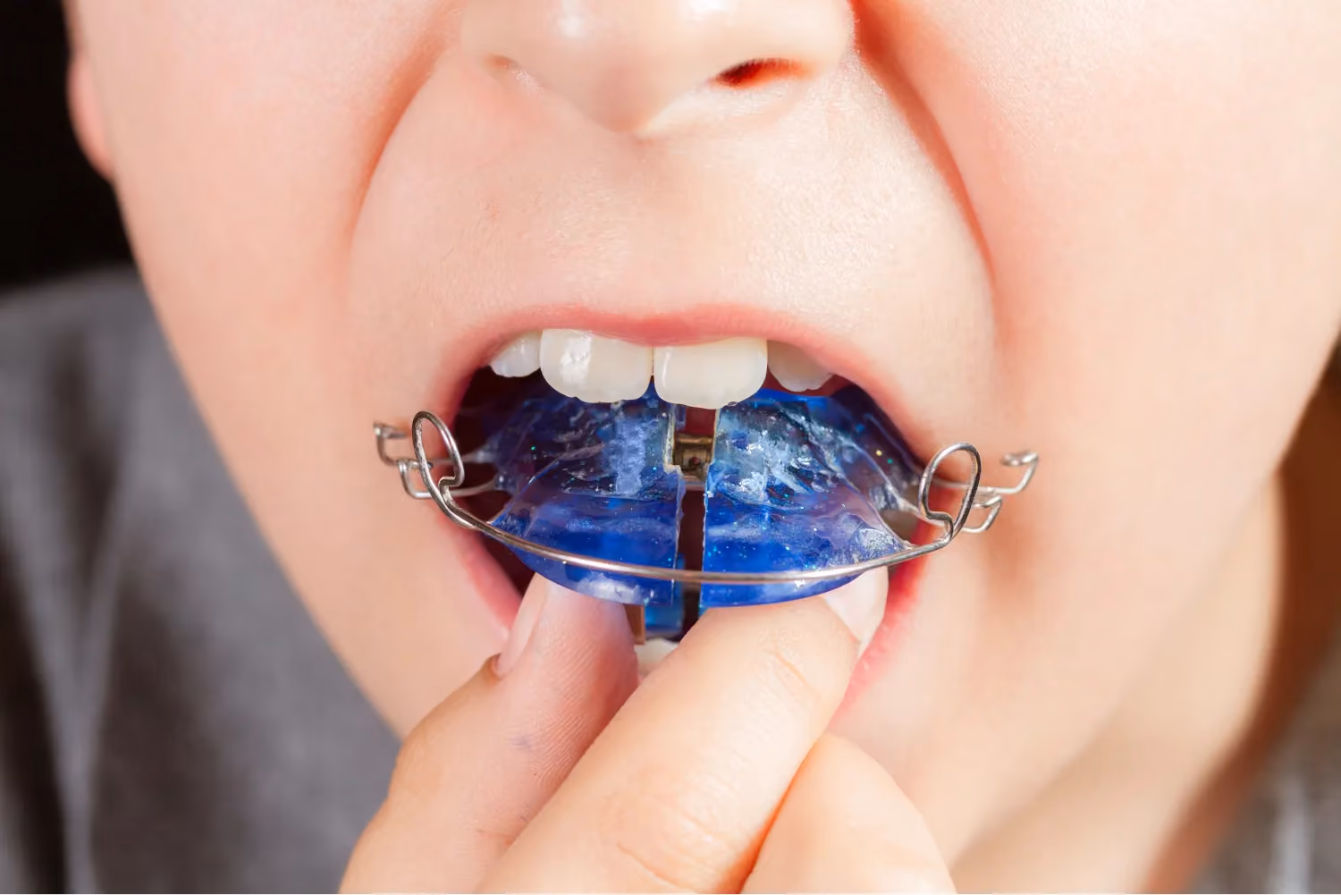 Early Interceptive Orthodontics