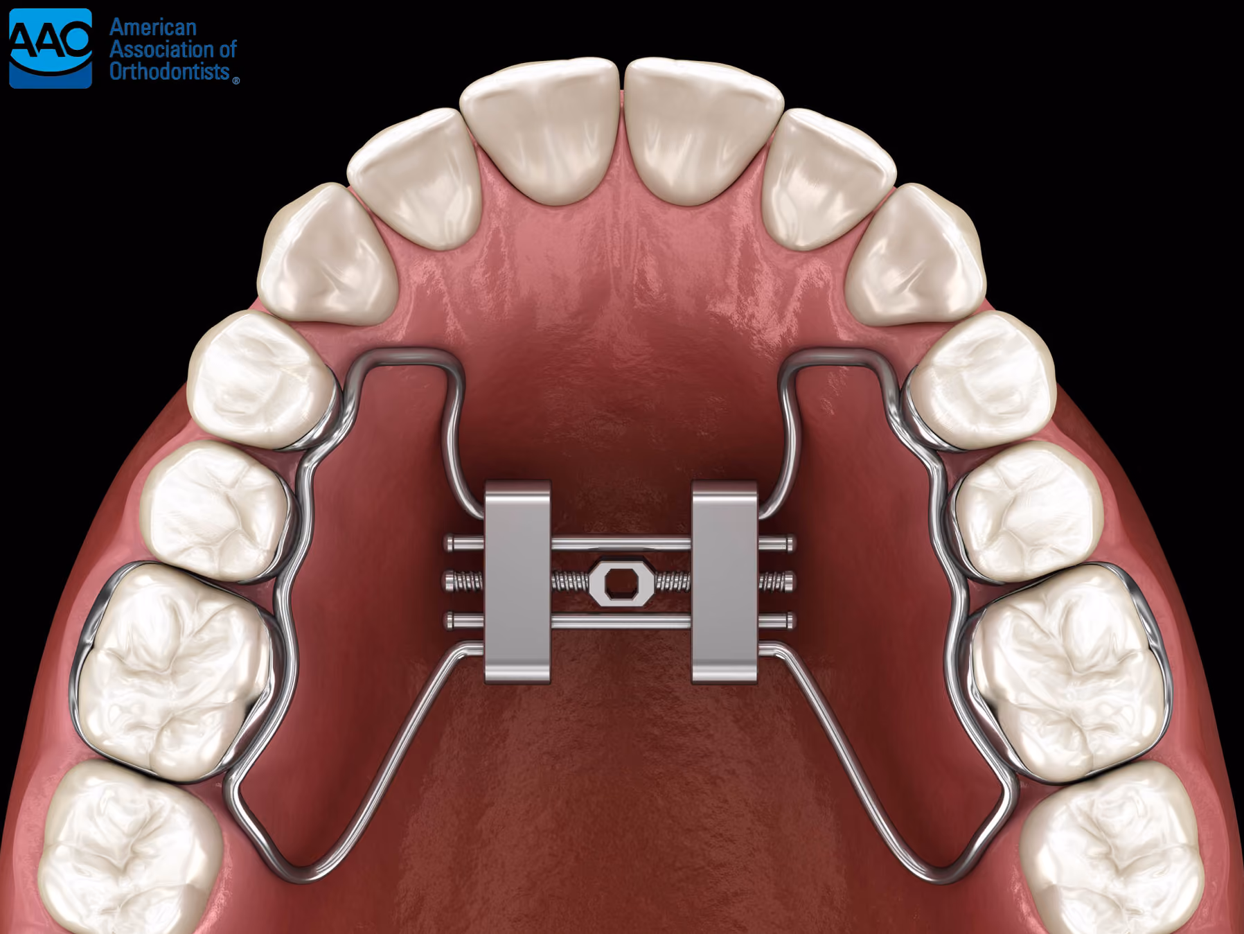 What are Palatal Expanders?