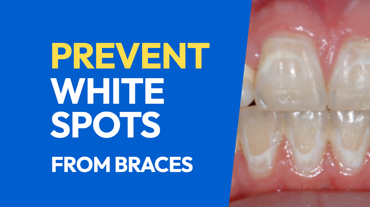 How to Prevent White Spots from Braces